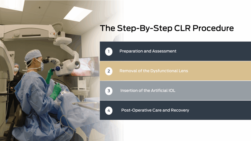 Graphic of CLR steps from lens removal to artificial IOL insertion