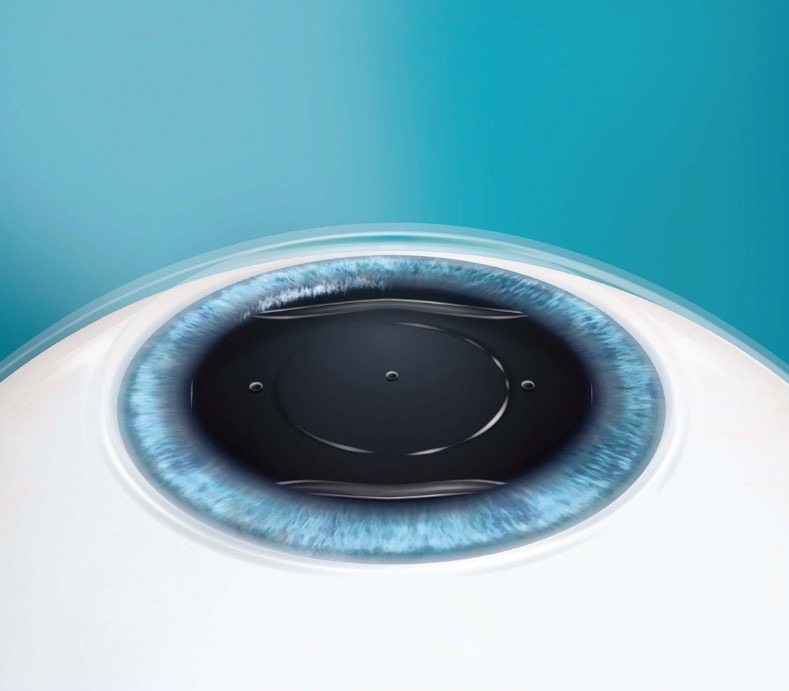 Eye with EVO ICL inserted